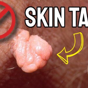 Best Skin Tag Removal Product Reviews (WORKS FAST!) | Get Rid Of Skin Tags Fast