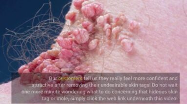 Where Can You Buy Derma Correct Mole And Skin Tag Remover (BEWARE: Is It WORTH It?!)