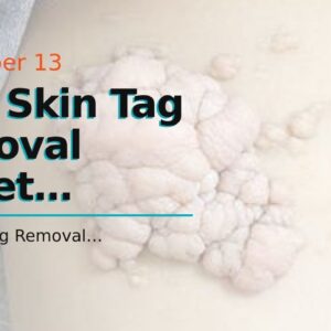 Best Skin Tag Removal Target (UPDATE: Does It Work?!)
