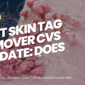 Best Skin Tag Remover Cvs (UPDATE: Does It Work?!)