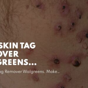 Best Skin Tag Remover Walgreens (UPDATE: What You Should Know!)