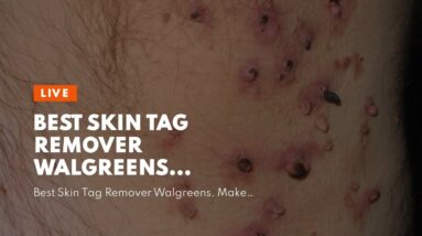 Best Skin Tag Remover Walgreens (UPDATE: What You Should Know!)