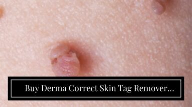 Buy Derma Correct Skin Tag Remover Online (WARNING: New Breakthrough!)