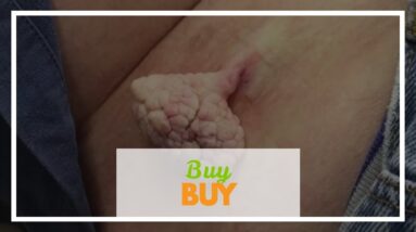 Buy Dermacorrect Mole Remover Online (UPDATE: New Breakthrough!)