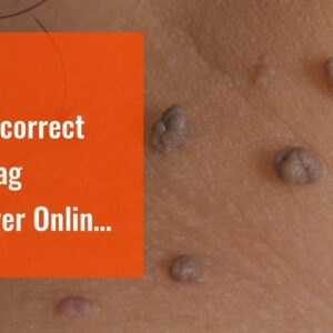 Buy Dermacorrect Skin Tag Remover Online (MUST SEE: Breakthrough!)