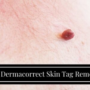 Buy Dermacorrect Skin Tag Remover (UPDATE: Breakthrough!)