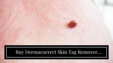 Buy Dermacorrect Skin Tag Remover (UPDATE: Breakthrough!)