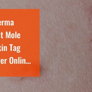 Buy Derma Correct Mole And Skin Tag Remover Online (MUST SEE: Is It WORTH It?!)