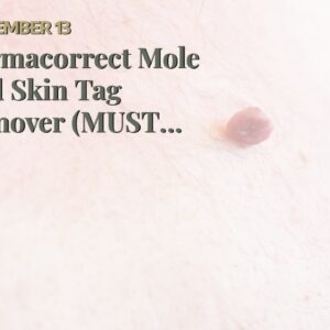 Dermacorrect Mole And Skin Tag Remover (MUST SEE: Truth About Skin Tags!)
