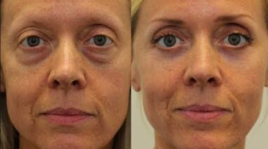 Eye Wrinkle Cream That Works - Erase 5 Years Off Your Face!