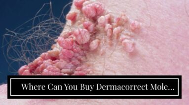 Where Can You Buy Dermacorrect Mole Remover (EXPOSED: Truth About Skin Tags!)