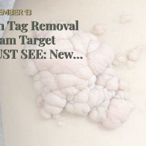 Skin Tag Removal Cream Target (MUST SEE: New Breakthrough!)