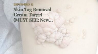Skin Tag Removal Cream Target (MUST SEE: New Breakthrough!)