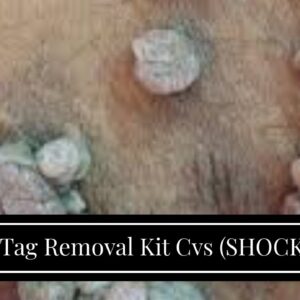 Skin Tag Removal Kit Cvs (SHOCKING: Does It Work?!)