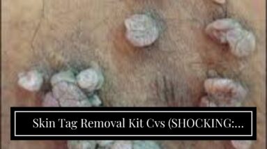 Skin Tag Removal Kit Cvs (SHOCKING: Does It Work?!)