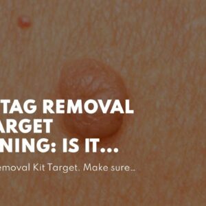 Skin Tag Removal Kit Target (WARNING: Is It LEGIT?!)