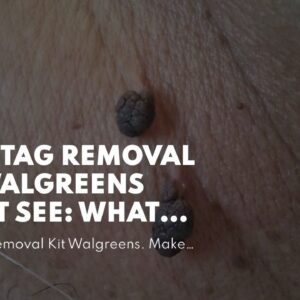 Skin Tag Removal Kit Walgreens (MUST SEE: What You Should Know!)