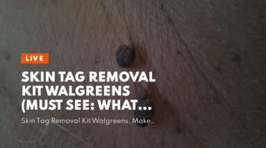 Skin Tag Removal Kit Walgreens (MUST SEE: What You Should Know!)