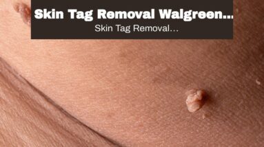 Skin Tag Removal Walgreens Cost (EXPOSED: What You Should Know!)