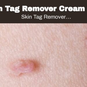 Skin Tag Remover Cream Cvs (UPDATE: What They Don't Tell You!)