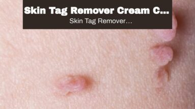 Skin Tag Remover Cream Cvs (UPDATE: What They Don't Tell You!)