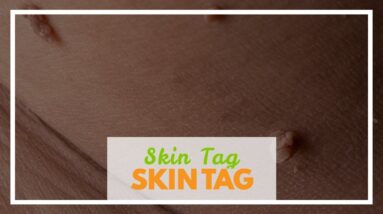 Skin Tag Remover Cvs (MUST SEE: New Breakthrough!)