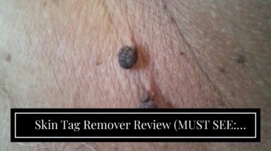 Skin Tag Remover Review (MUST SEE: Breakthrough!)