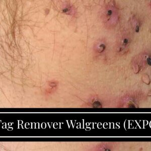 Skin Tag Remover Walgreens (EXPOSED: Is It LEGIT?!)