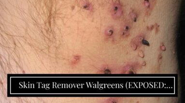 Skin Tag Remover Walgreens (EXPOSED: Is It LEGIT?!)