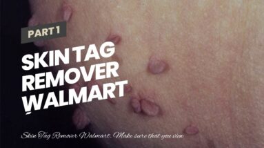 Skin Tag Remover Walmart (SHOCKING: Is It WORTH It?!)