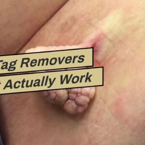 Skin Tag Removers That Actually Work (EXPOSED: What You Should Know!)