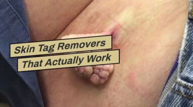 Skin Tag Removers That Actually Work (EXPOSED: What You Should Know!)