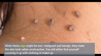 Where To Purchase Derma Correct Mole Remover (EXPOSED: Breakthrough!)